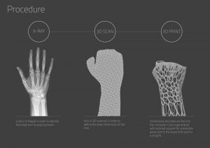 cortex exoskeletal cast xray, 3d scan and 3d print process